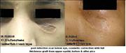 Before After Pictures,Cosmetic surgery,Delhi,  scar removal 